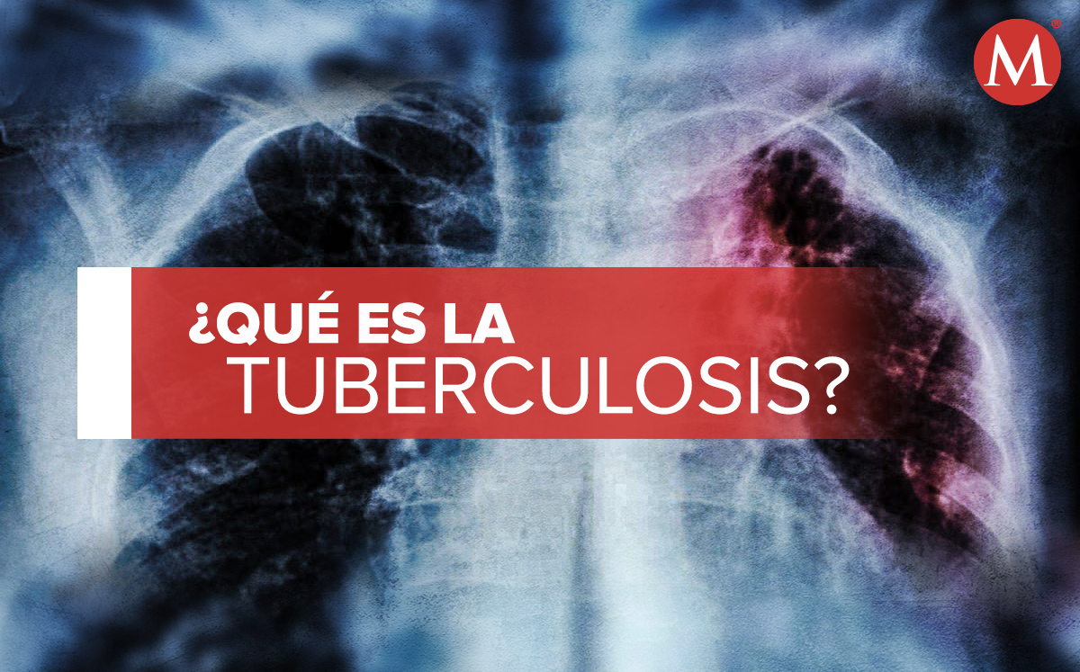 La tuberculosis es una enfermedad causada por una bacteria; a comparación del covid-19 que es de un virus. (Especial)