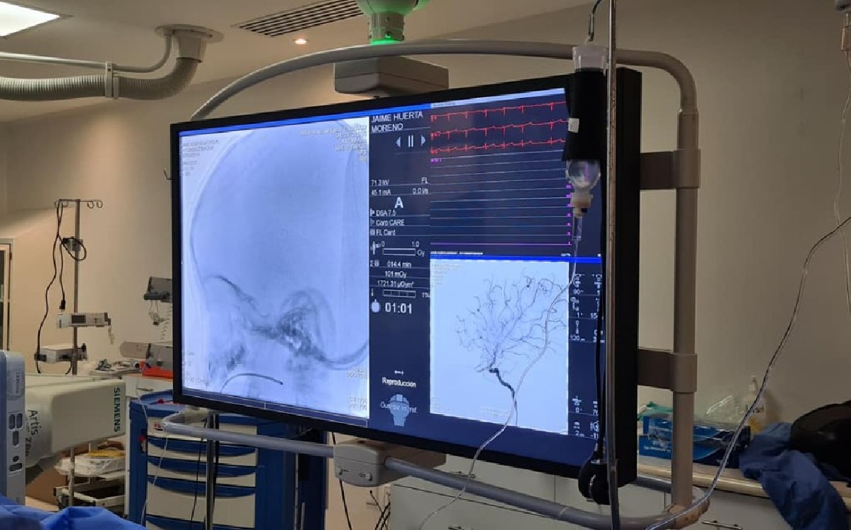 Se realizó con éxito la aplicación de quimioterapia intraarterial. (Especial)