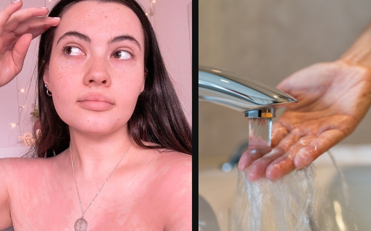 Joven revela extraño padecimiento en su piel; es alérgica al agua, saliva y sudor. (Especial)