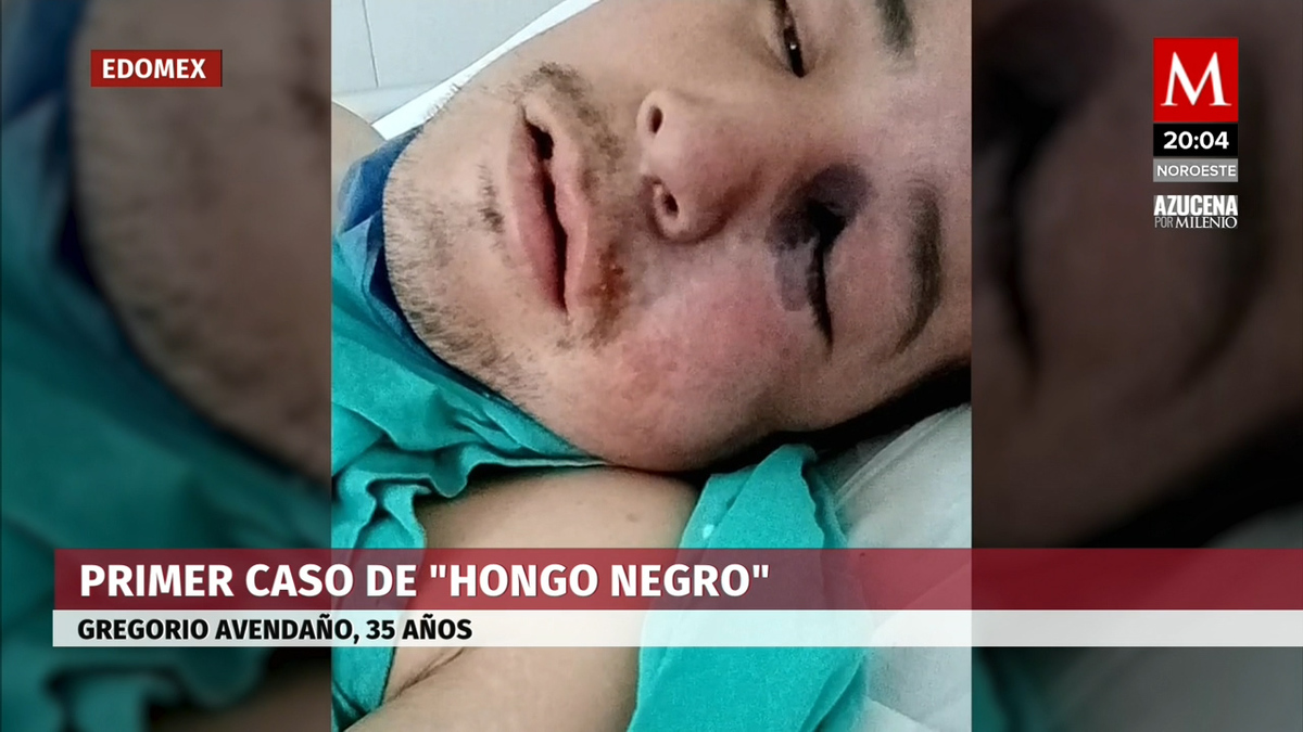 Se confirmó un posible primer caso de Hongo Negro en EdMx