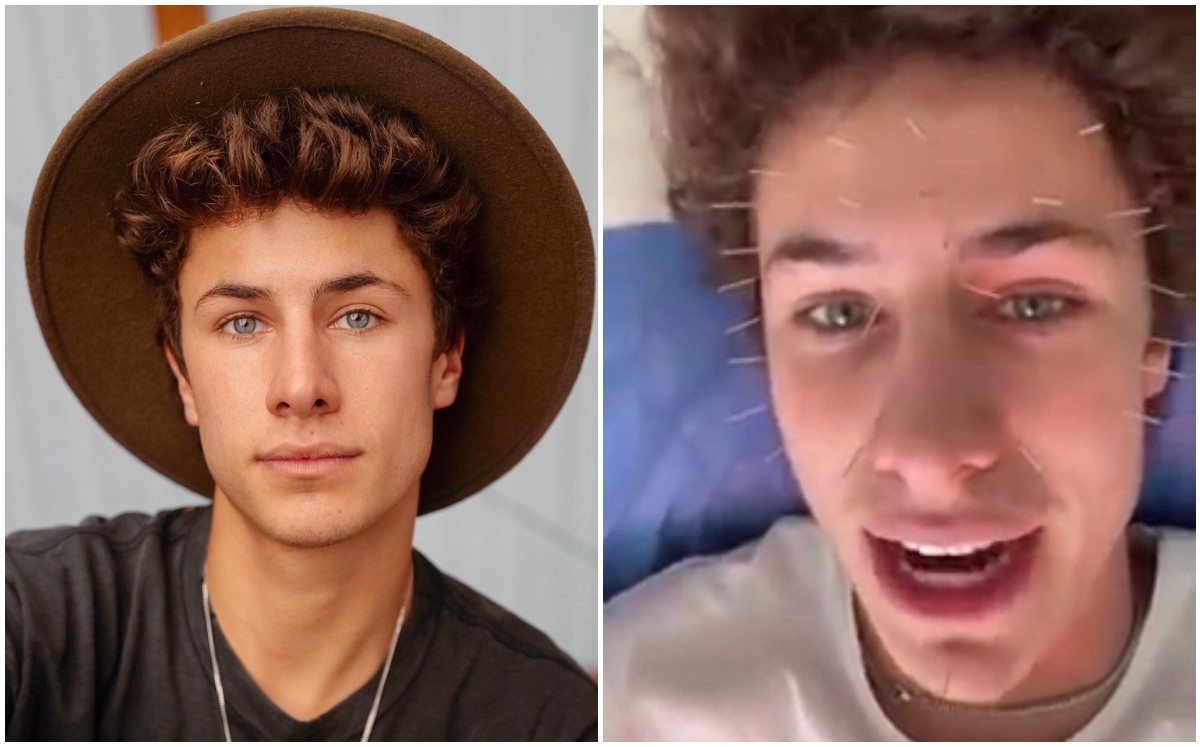 Juanpa Zurita y su terapia de acupuntura (Especial).
