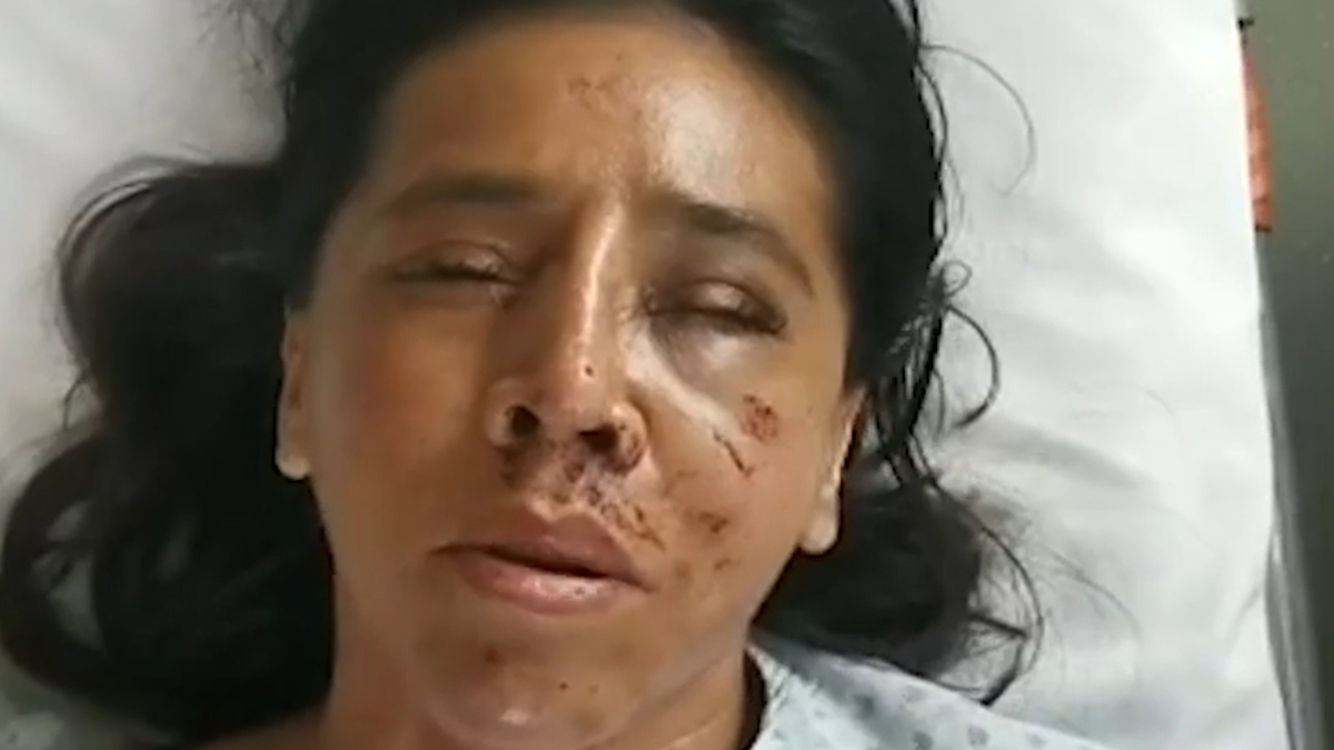 Aracely fue atacada por su pareja; autoridades dejan libre al agresor