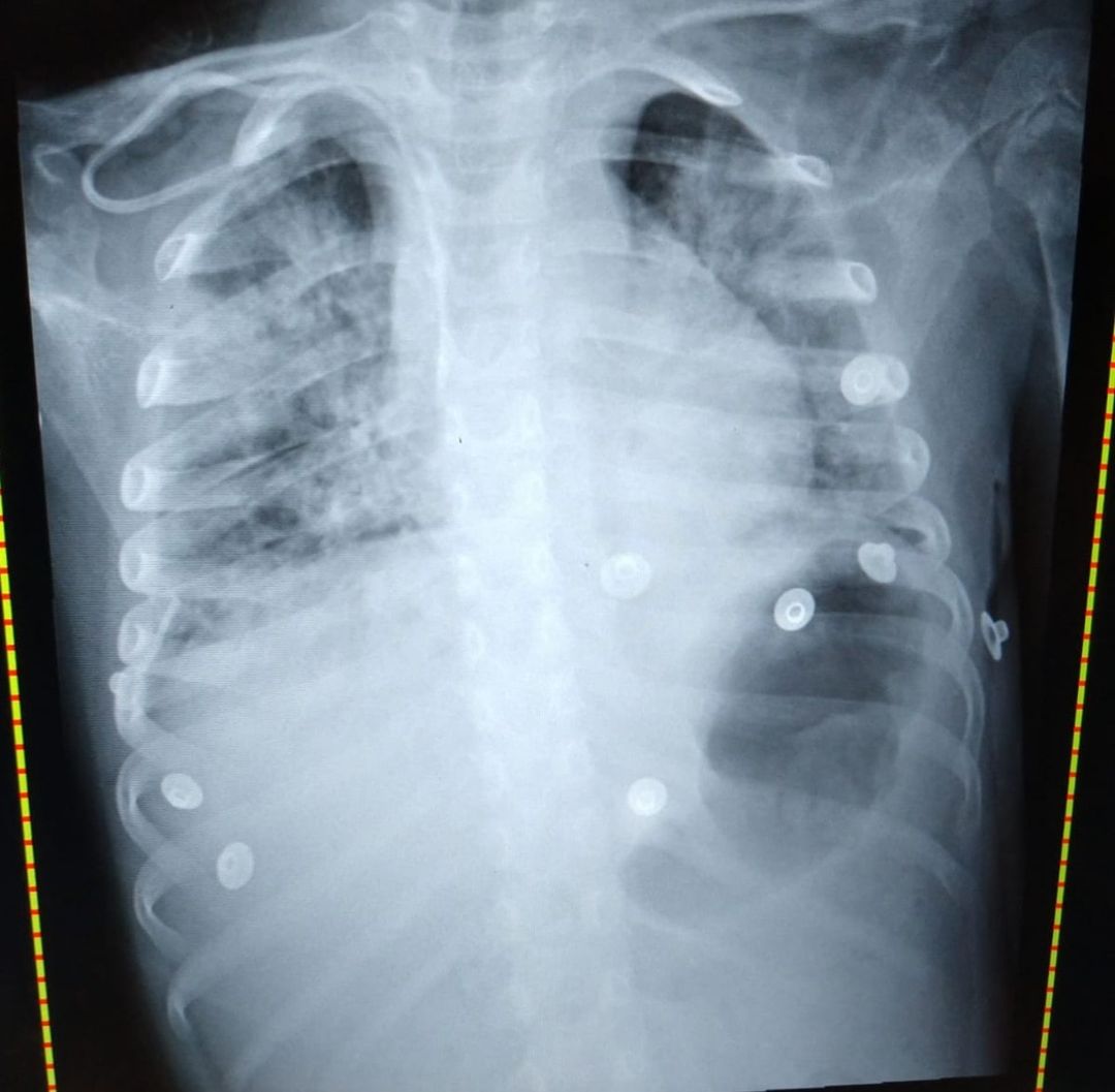 Narra doctor la batalla de una niña contra el covid-19 en Nuevo León. Foto: Especial