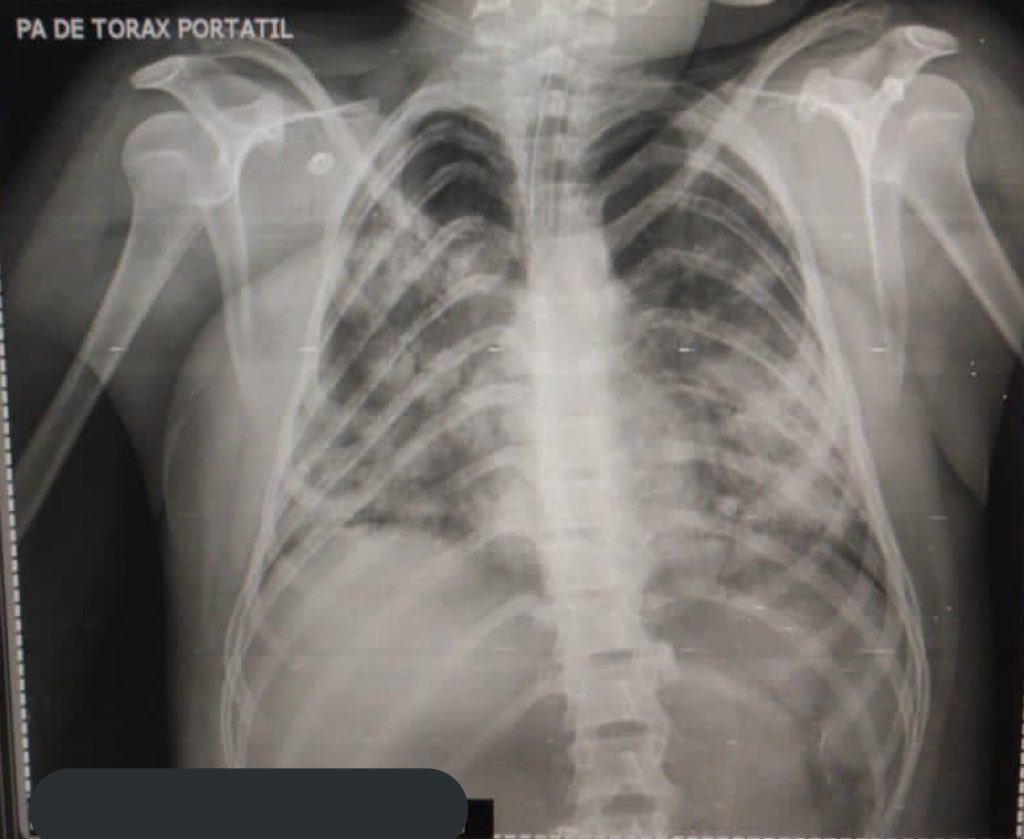 La radiografía de unos pulmones destapa covid-19 en adolescentes | Especial