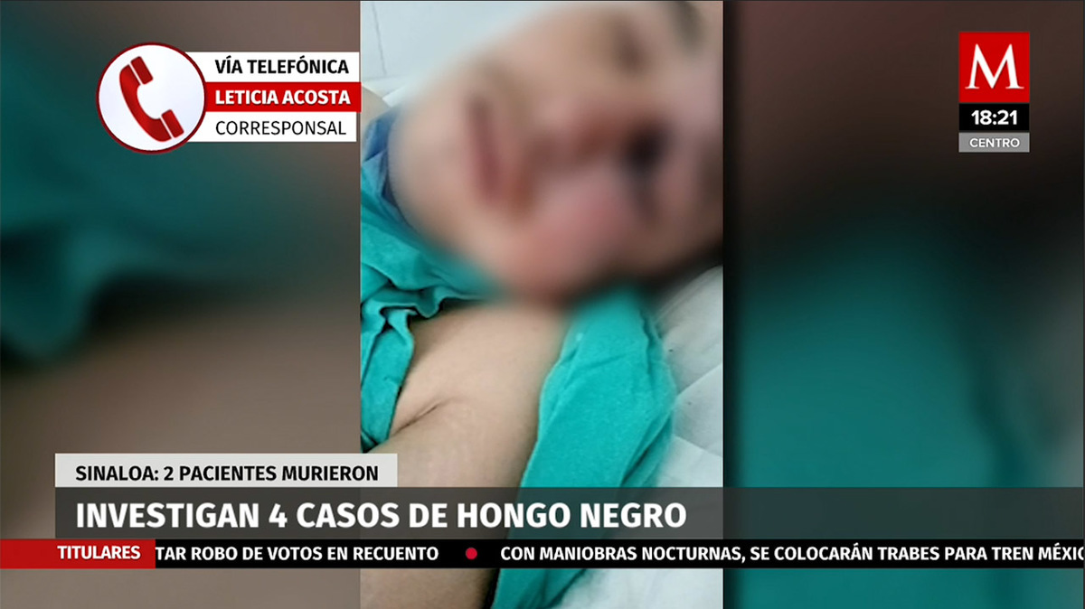 Casos de hongo negro en Sinaloa, 2 pacientes han fallecido