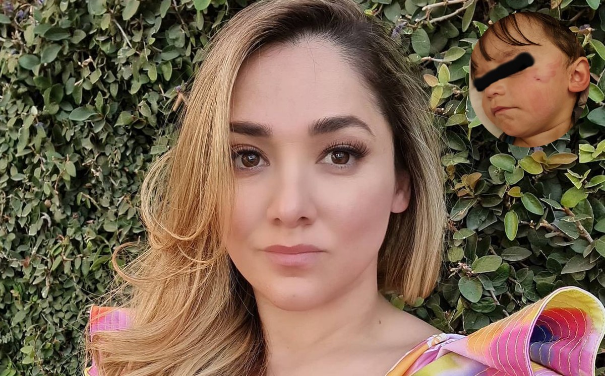 Hijo de Sherlyn sufre lesión en el rostro tras mordida de su perrita (Especial).