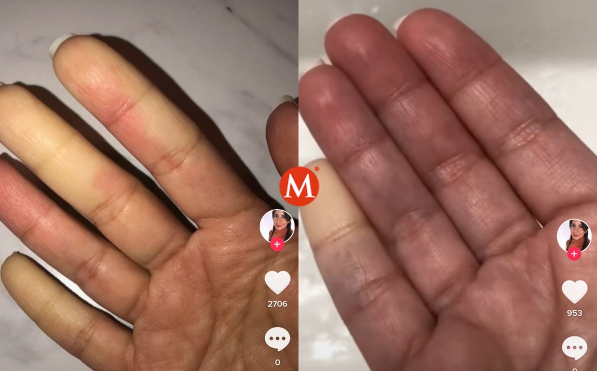 Joven en tiktok expone su enfermedad de Raynaud.