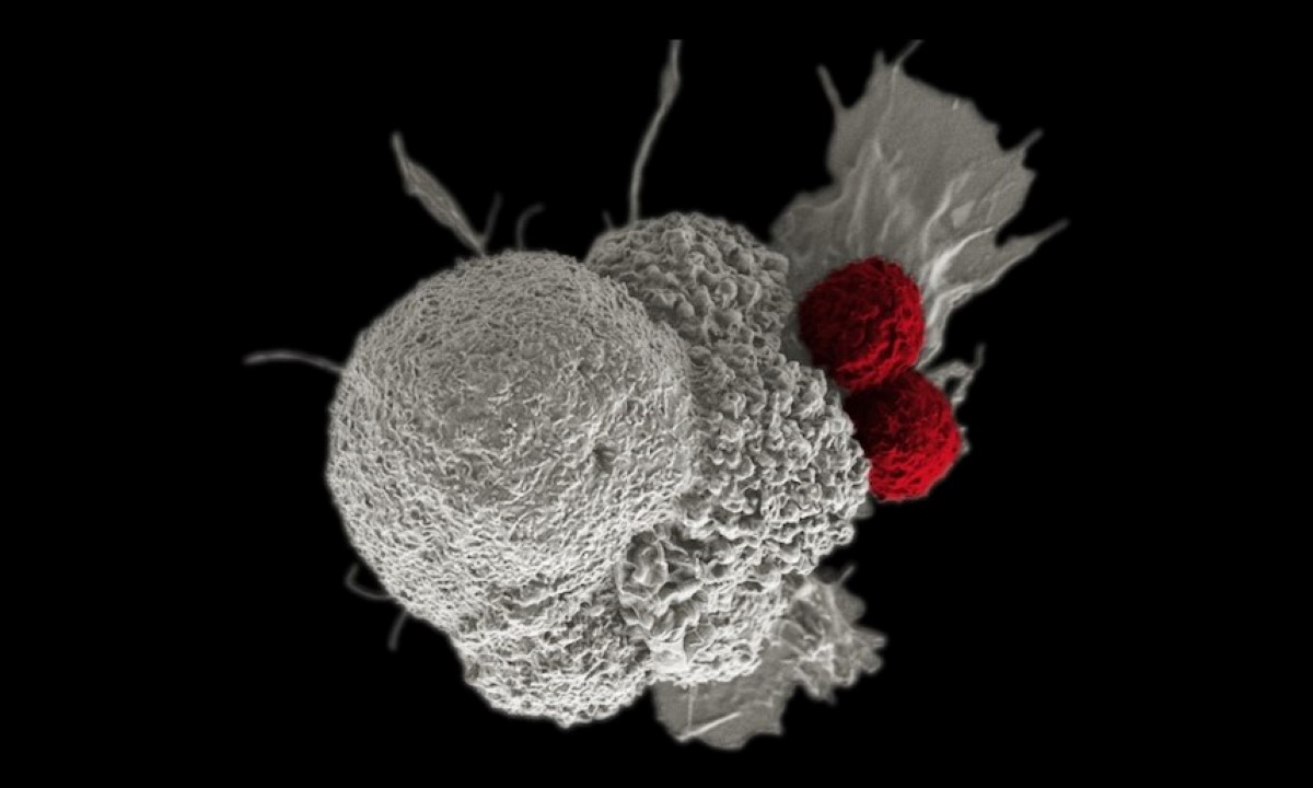 La inmunoterapia combina los medicamentos nivolumab e ipilimumab. | Especial