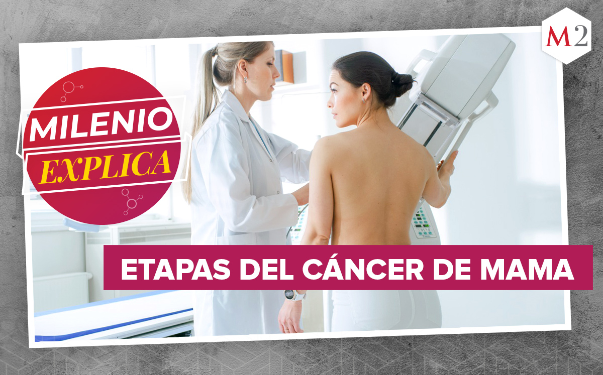 Las etapas del cáncer de mama pueden dividirse | Shutterstock