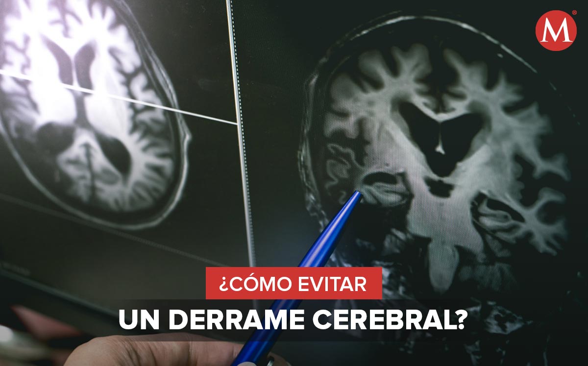 Un derrame cerebral puede ser provocado por los malos hábitos de vida | Especial