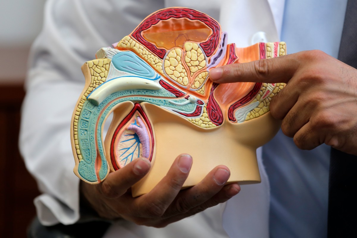 El cáncer de próstata no da síntomas en etapa inicial ni en etapa intermedia. | Mauricio Román