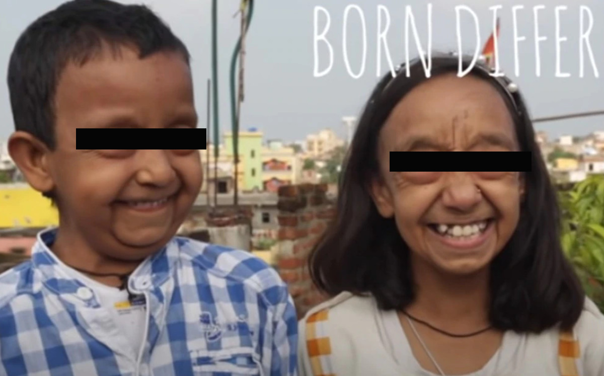 Hermanos niños parecen tener 80 años por raro trastorno genético. (Especial)