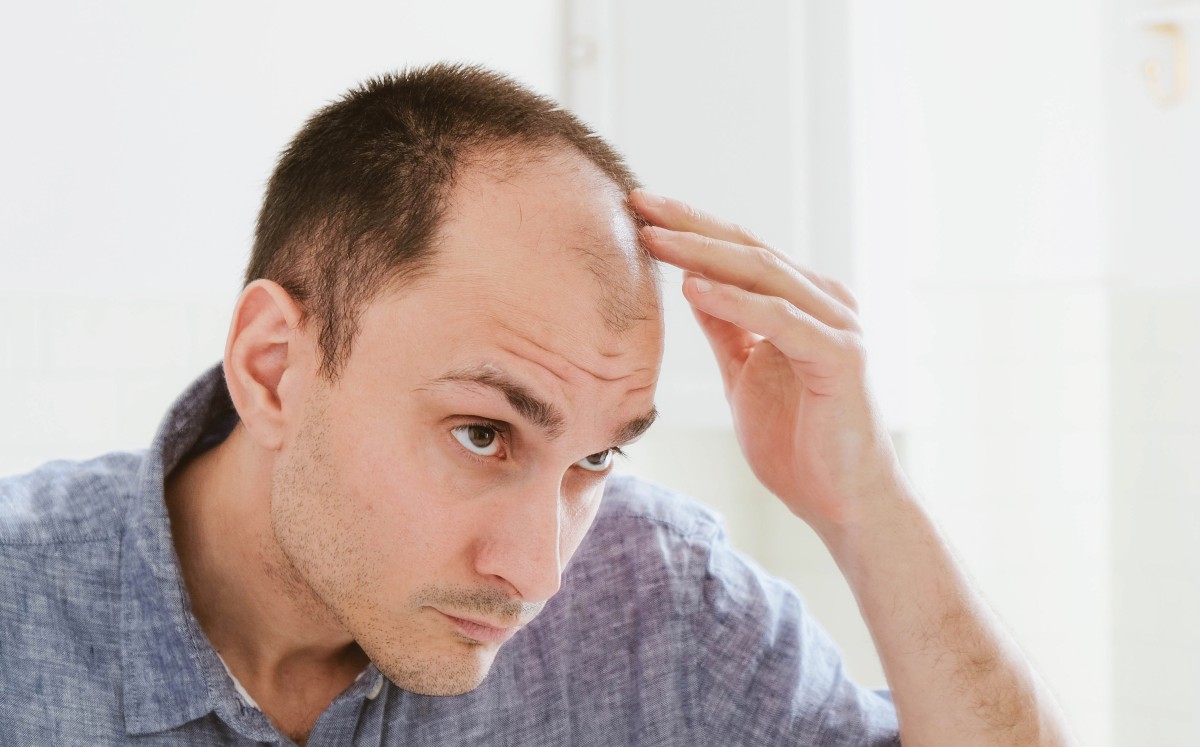 Los injertos, la solución amable para quienes padecen calvicie (Shutterstock).