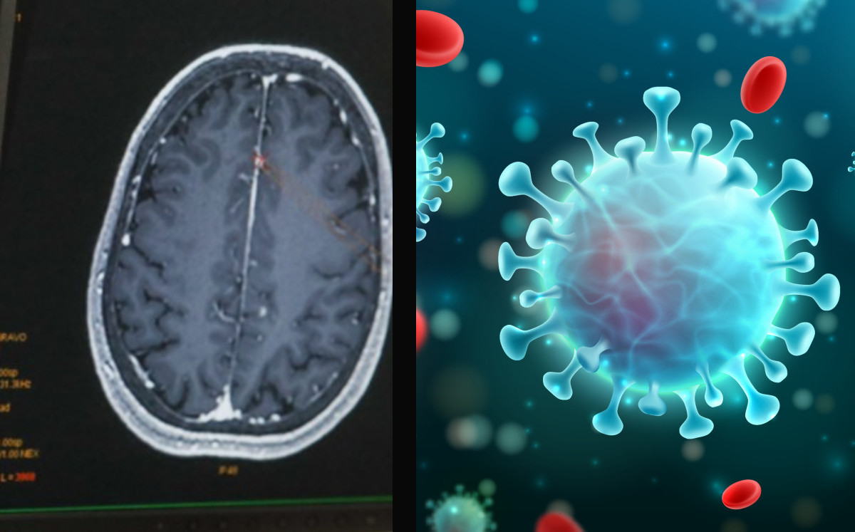 El coronavirus SARS-CoV-2 puede afectar el cerebro: estudio. |Especial