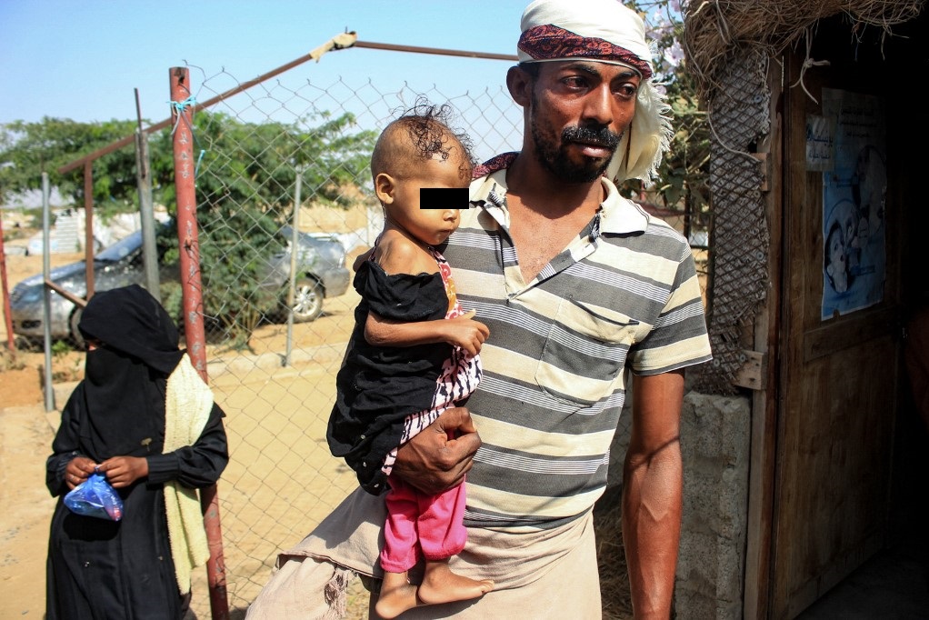 La pequeña tiene un grave nivel de desnutrición en un país afectado por la guerra. | Foto: AFP