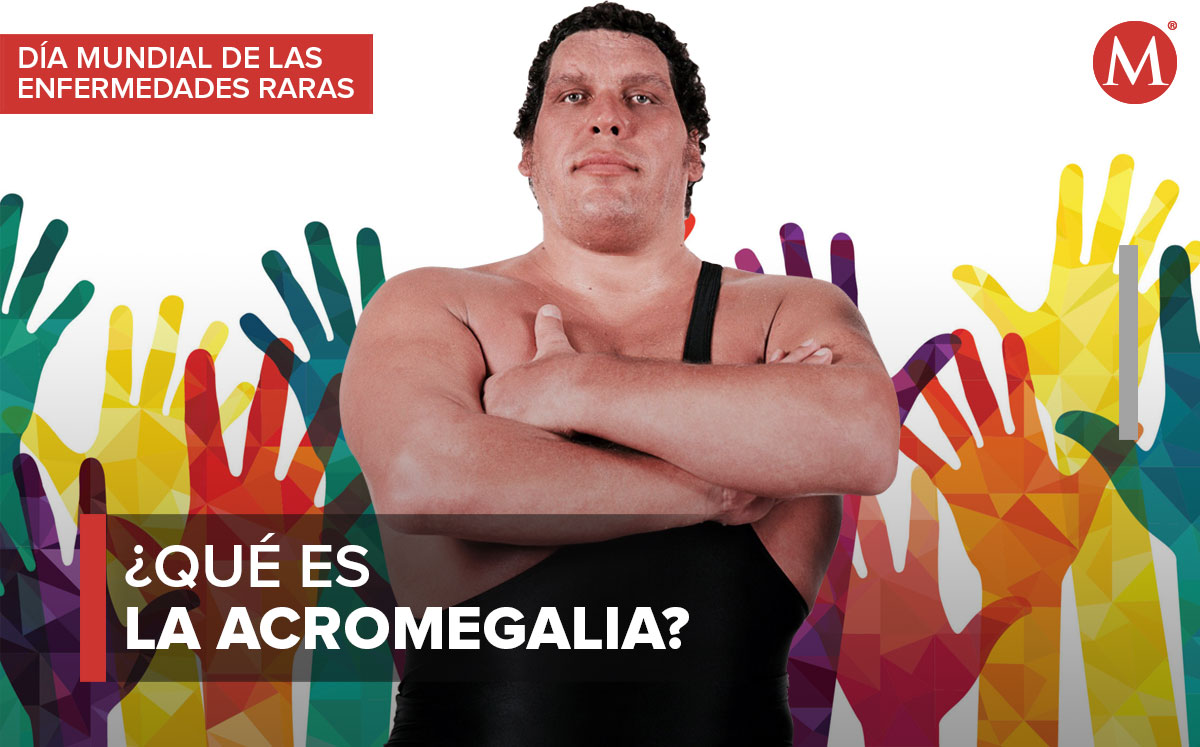 La acromegalia es una enfermedad rara en el mundo | Especial