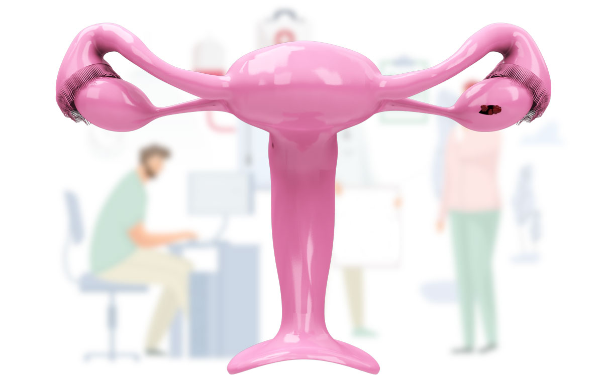 El cáncer de ovario es uno de los más frecuentes en mujeres | Shutterstock
