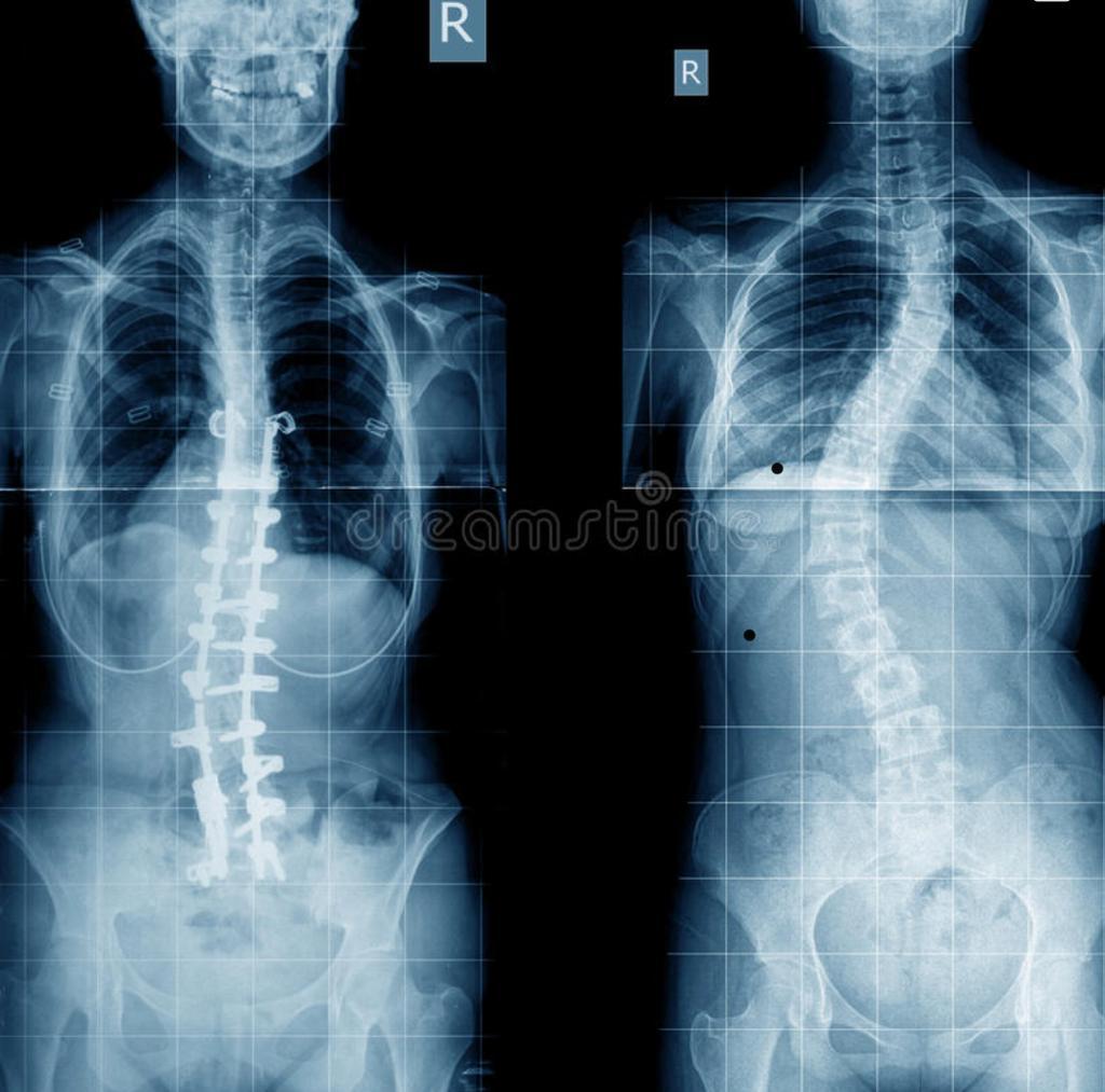 Las afectaciones en la columna vertebral puede generar padecimientos más graves en el futuro. (Especial)