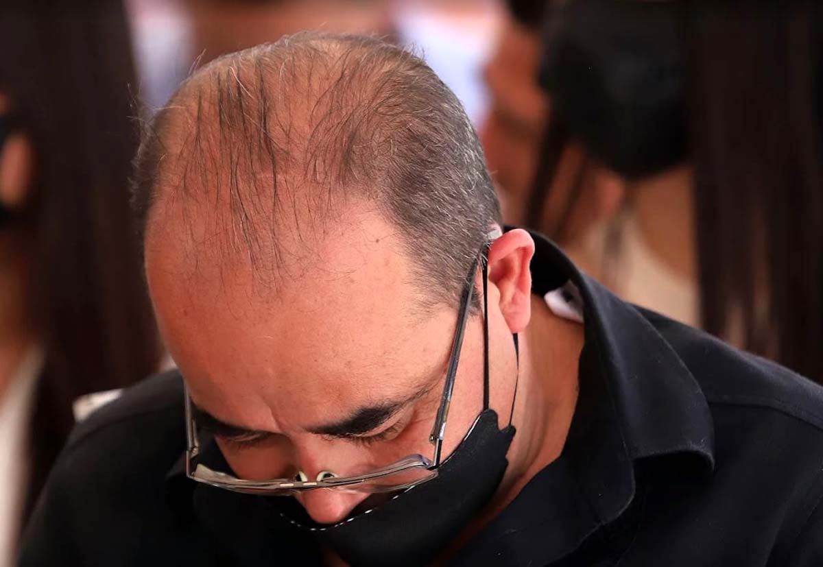 Alopecia. (Rolando Riestra)