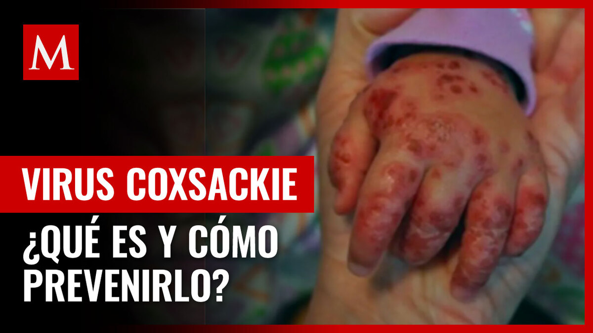 ¿Qué es el virus Coxsackie y cómo prevenirlo?
