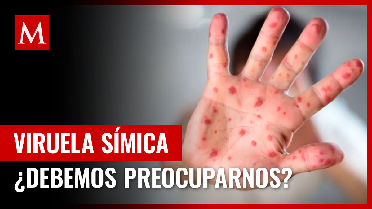 Reino Unido confirma cuatro casos de viruela símica