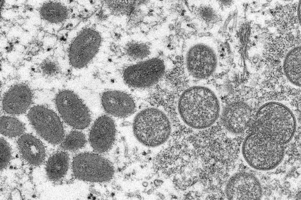 Madrid confirma 30 casos de viruela del mono | AP