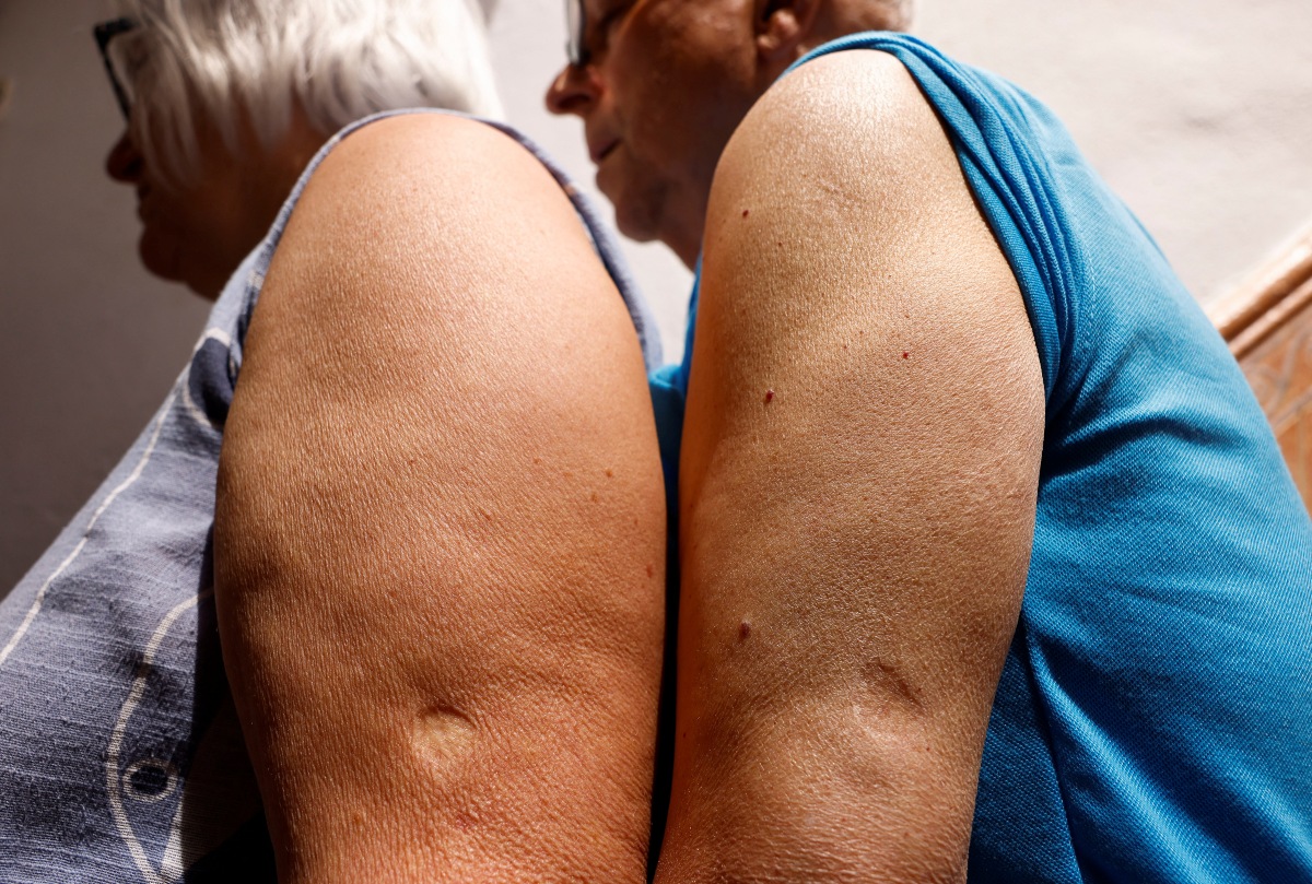 La viruela del mono tiene vacuna; decenas de personas han recibido alguna de las dosis. (Reuters)