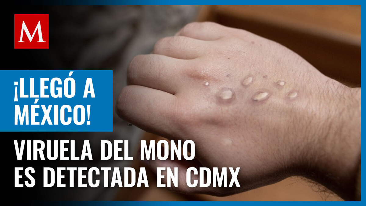 Detectan primer caso de viruela del mono en México