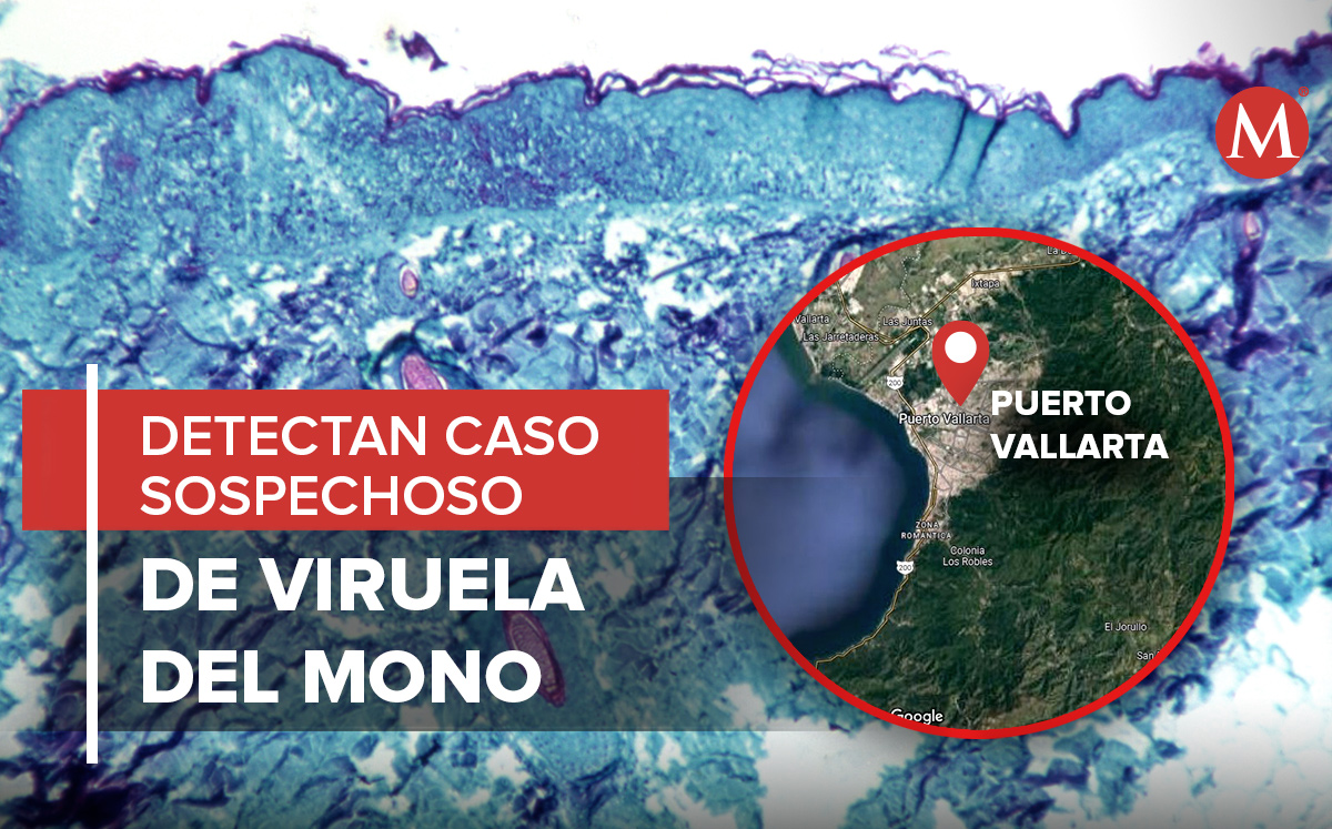 Reportan casos sospechoso de Viruela del mono en Puerto Vallarta (Reuters y Google Maps)