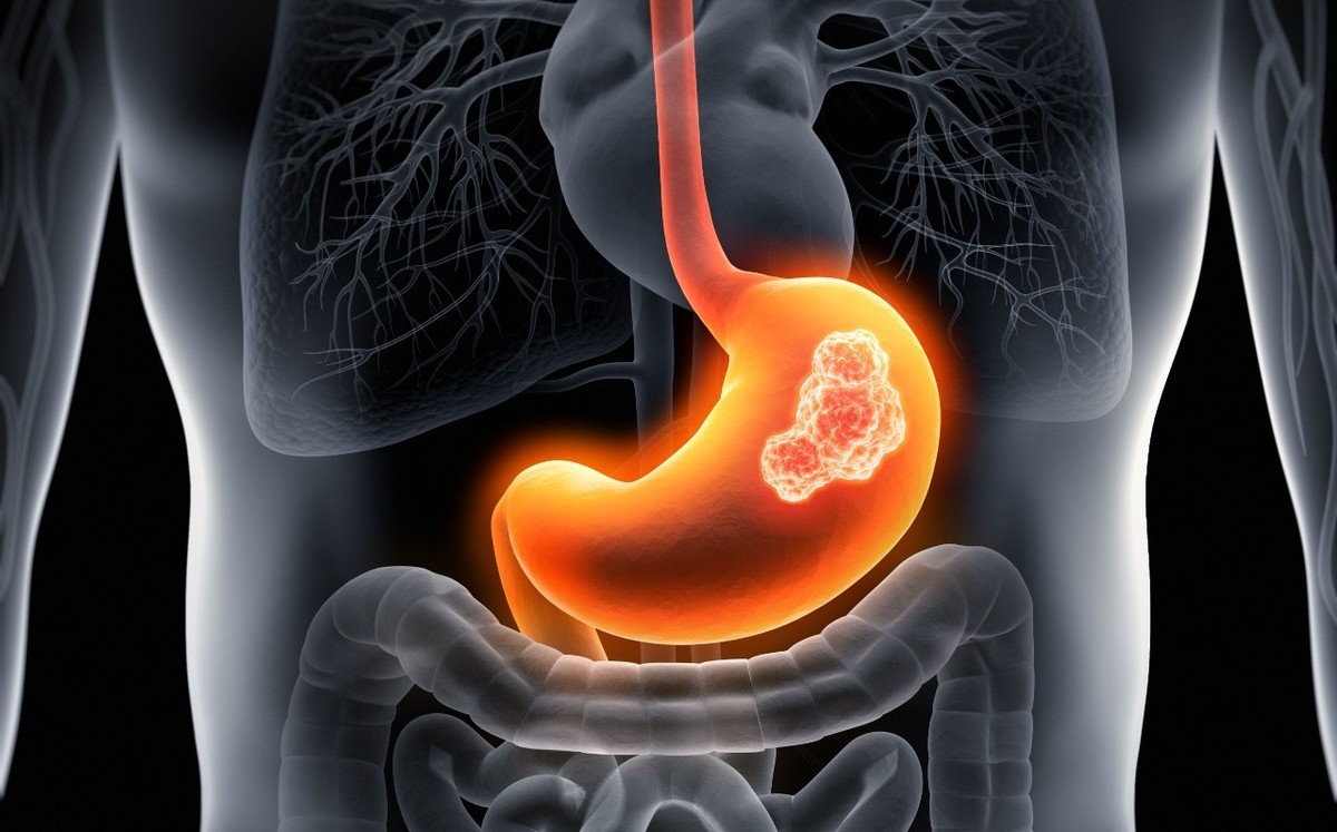 El cáncer gástrico está relacionado con la edad y es difícil de prevenir (Shutterstock).