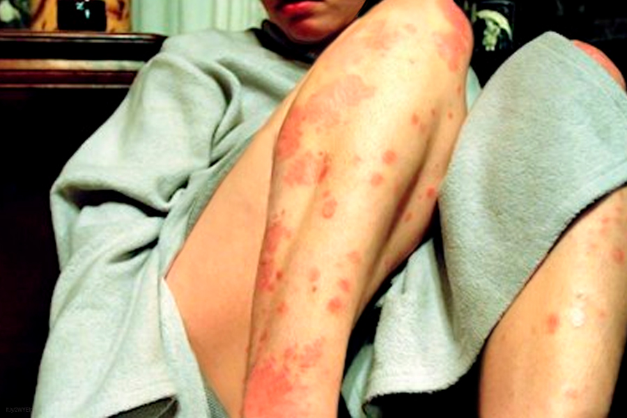 Dermatitis atópica. (UNAM)