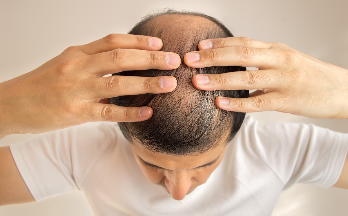 La alopecia es un padecimiento que afecta principalmente a los hombres. | Shutterstock