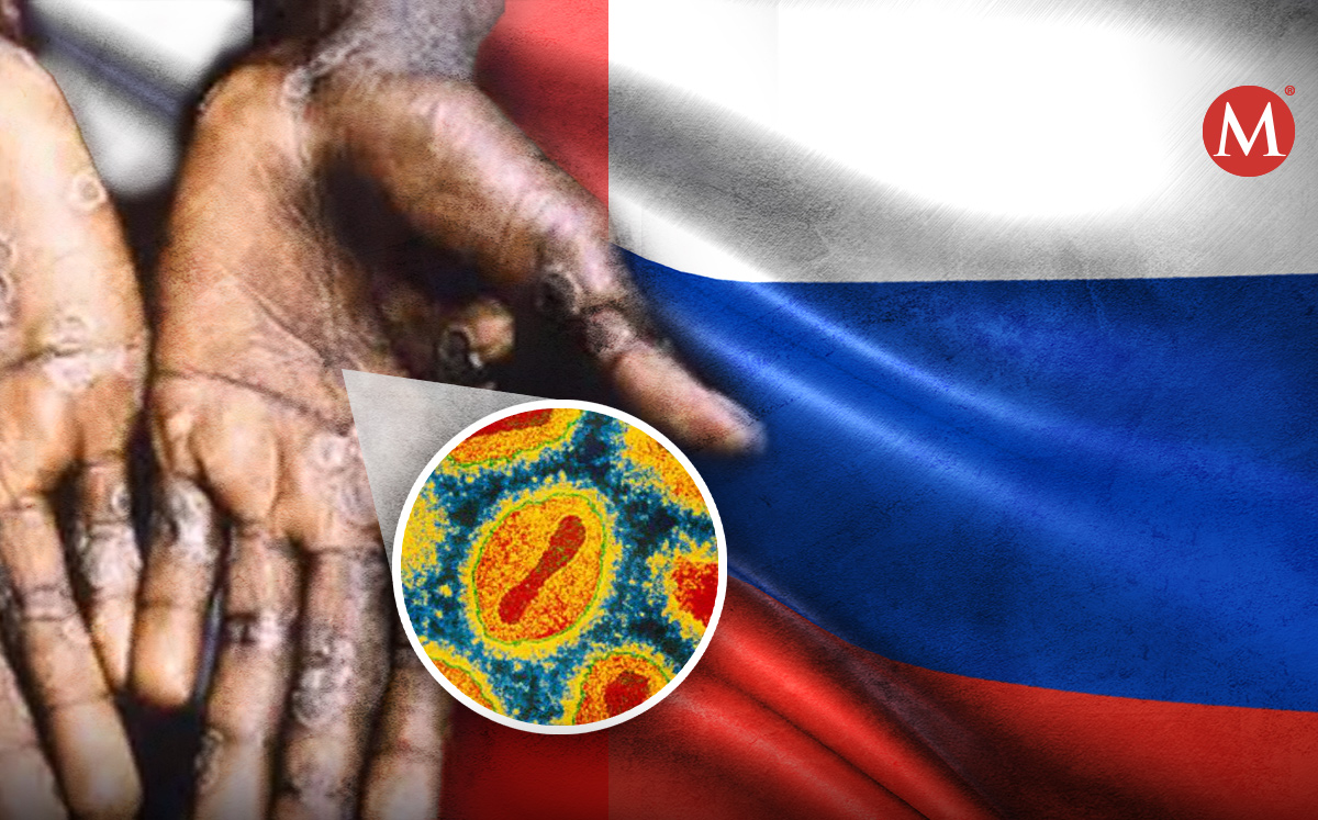 Rusia detecta primer caso de viruela del mono. (Especial)