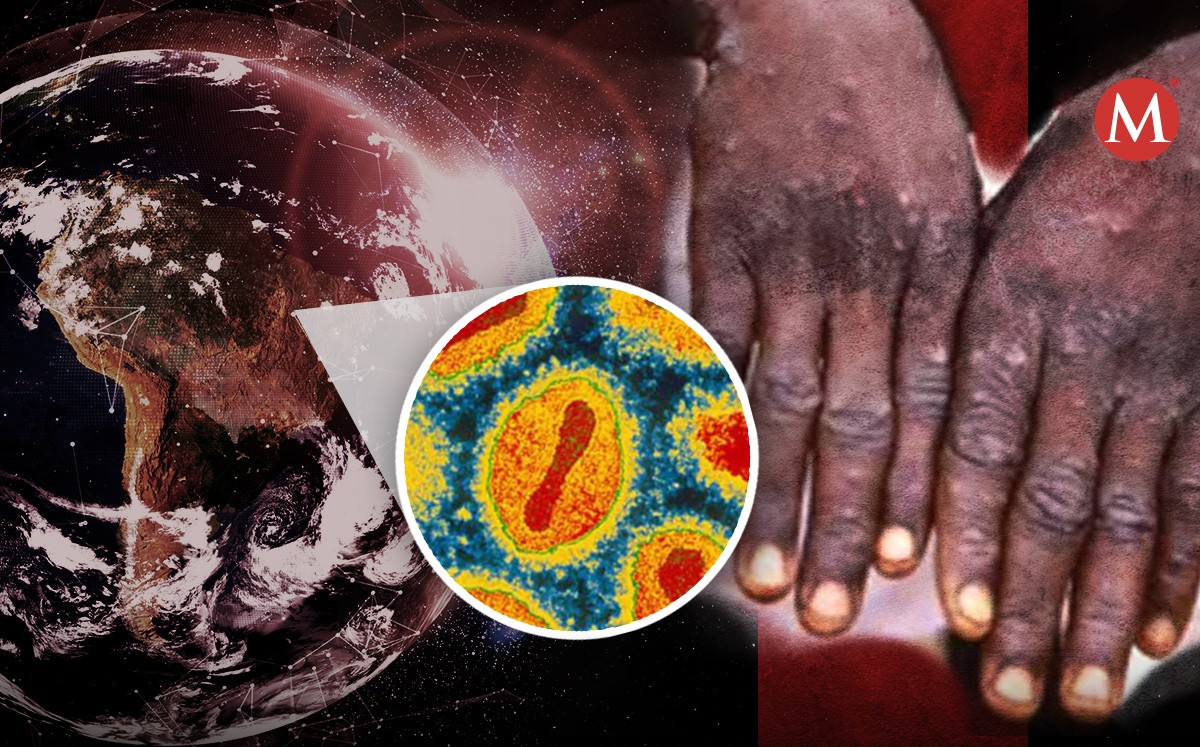 OMS declara viruela del mono como emergencia internacional | Especial