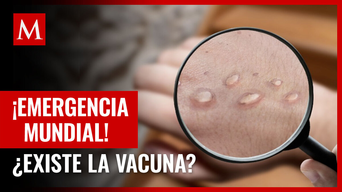 ¿Existe la vacuna contra la viruela del mono? Esto sabemos