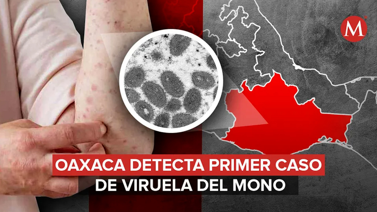 Confirman primer caso de viruela en Oaxaca