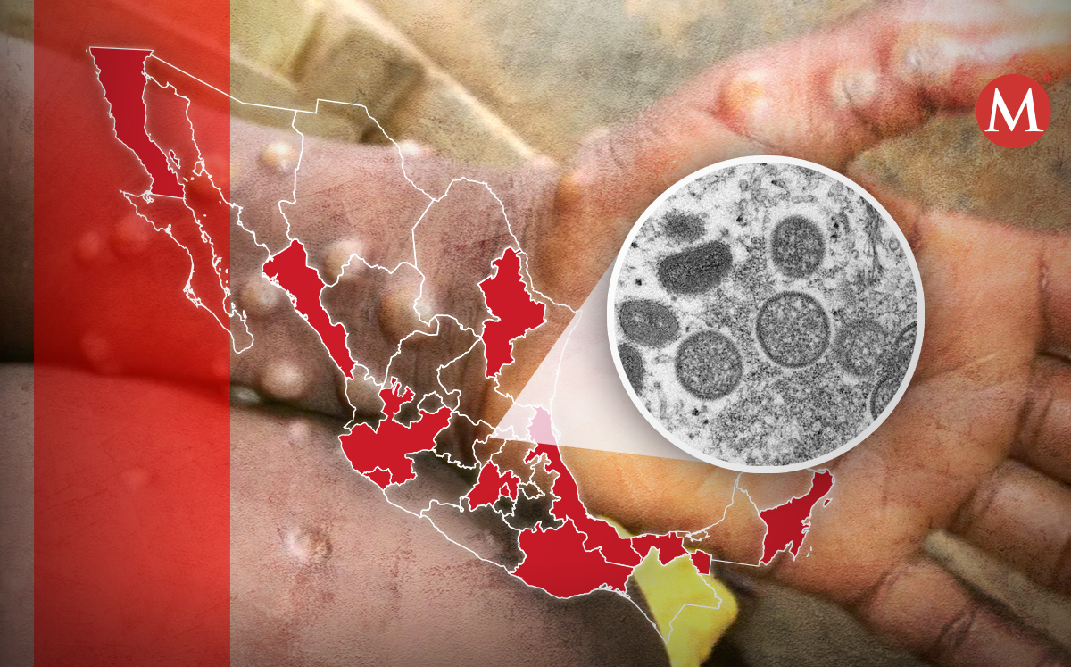 La viruela símica ha afectado a más de cinco entidades de la República. | Especial