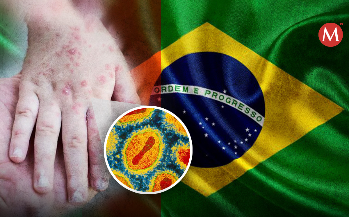 Brasil informó sobre la reciente muerte de un paciente con viruela símica. | Especial