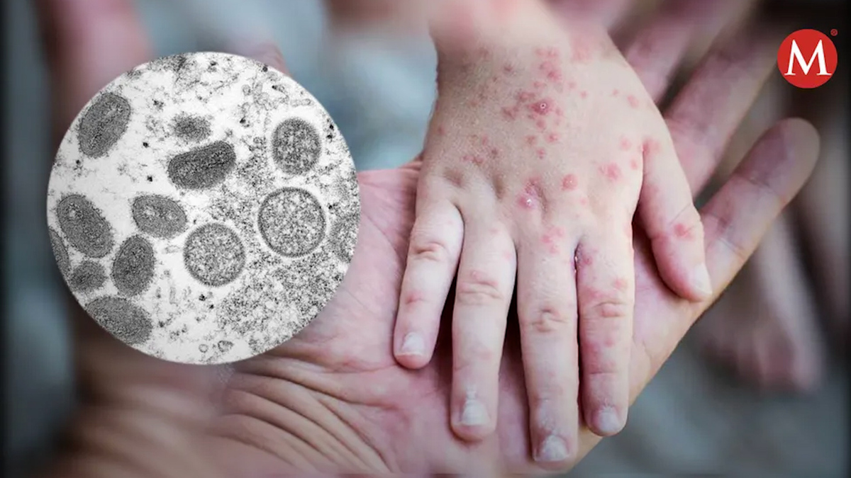 Confirman primeros dos casos de la viruela del mono en Puebla