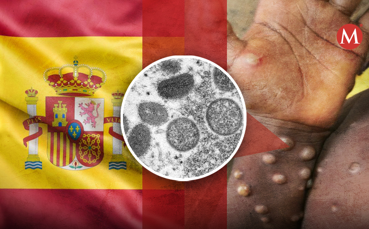 España confirma su primera muerte por viruela del mono | Especial