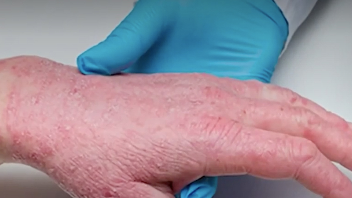 Viruela del mono podría ser una enfermedad de transmisión sexual