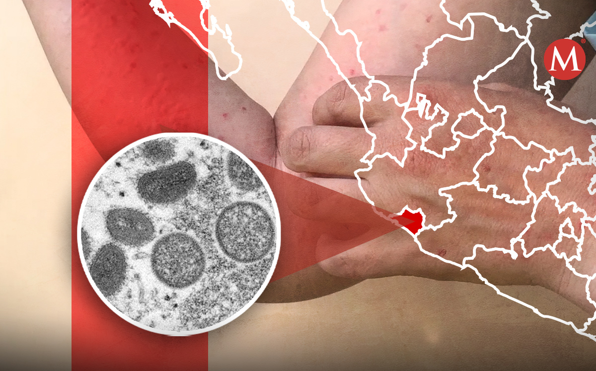 La Secretaría de Salud de Colima investiga los casos posibles de la viruela del mono en  la entidad. | Shutterstock