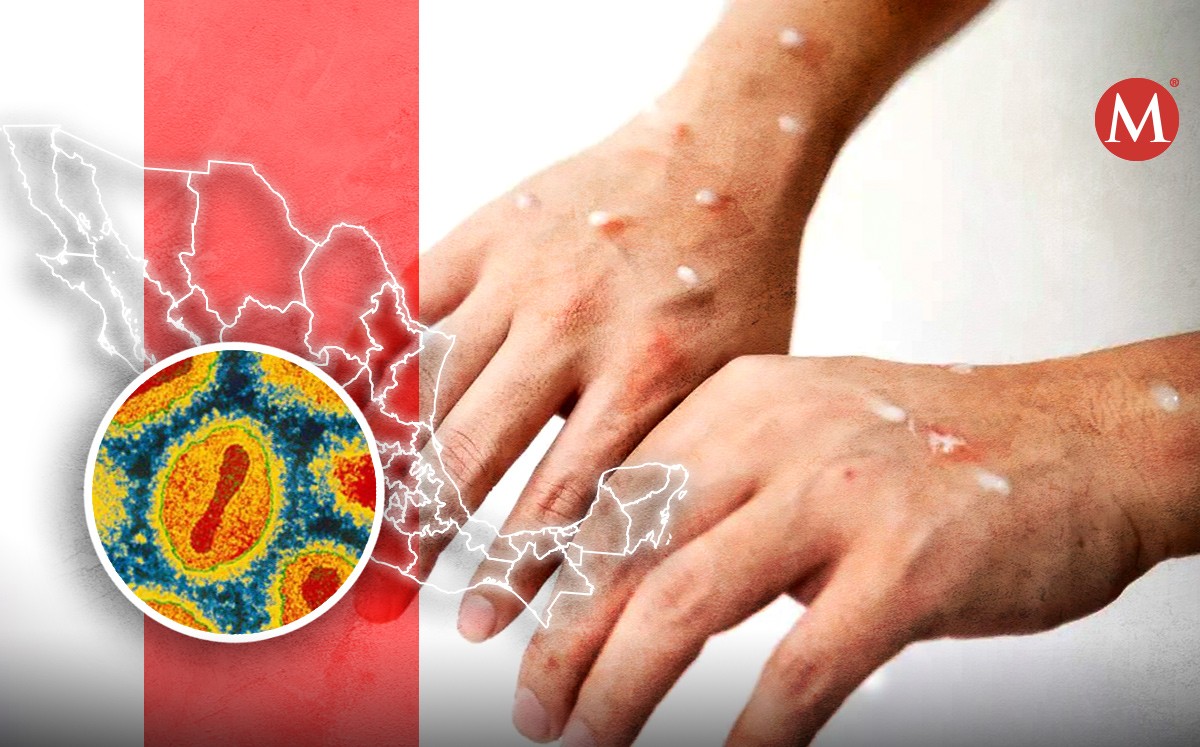 La Ciudad de México acumula 75 contagios de viruela del mono.| Diseño: Margarita Salmorán Mejía
