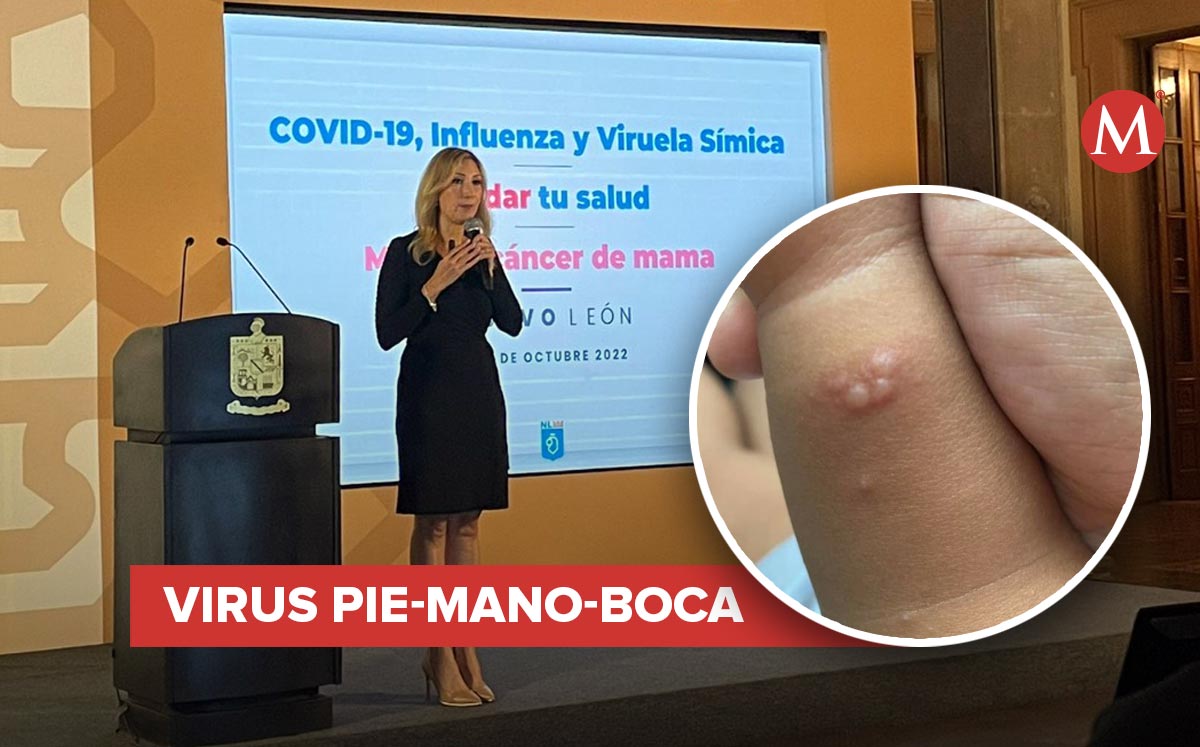El virus se llama “pie, mano, boca”, y es muy contagioso. Foto: Especial