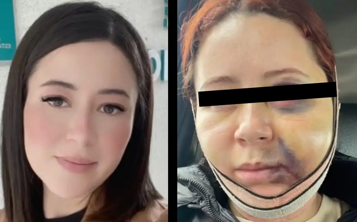 Mujer se hace bichetomía: resultado preocupa | ESPECIAL