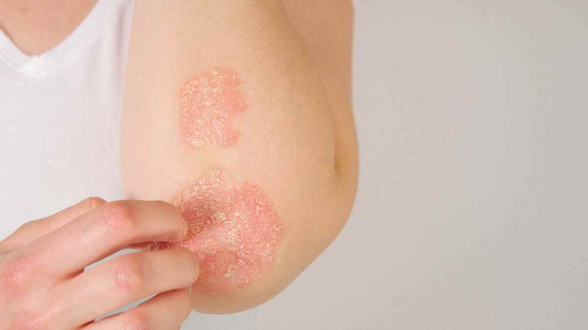 Psoriasis (Shutterstock).