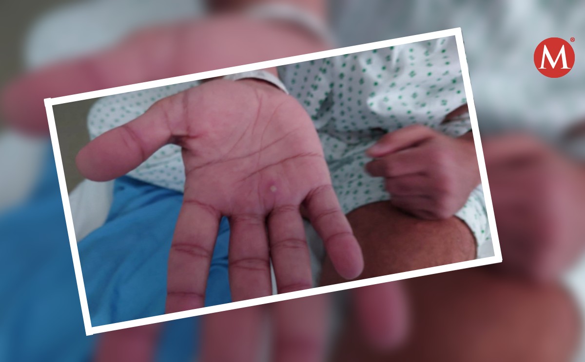 Un hospitalizado por viruela del mono en Tamaulipas; ya suman 11 casos