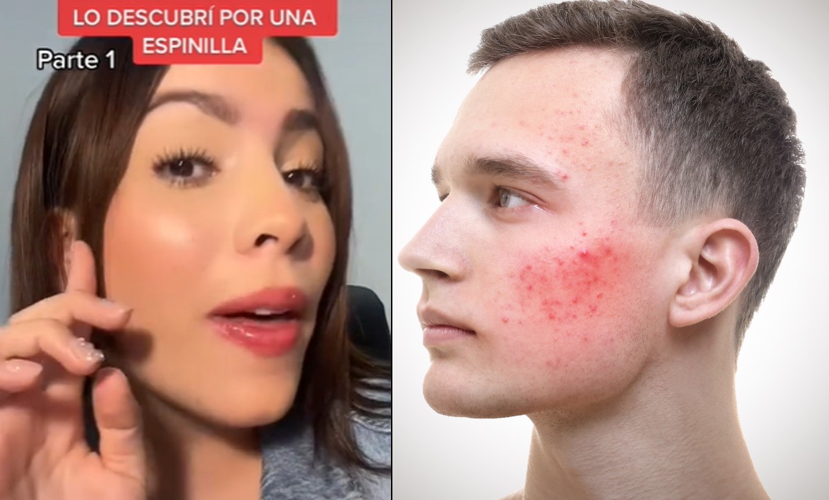 Joven descubre que su novio le es infiel por un grano | ESPECIAL