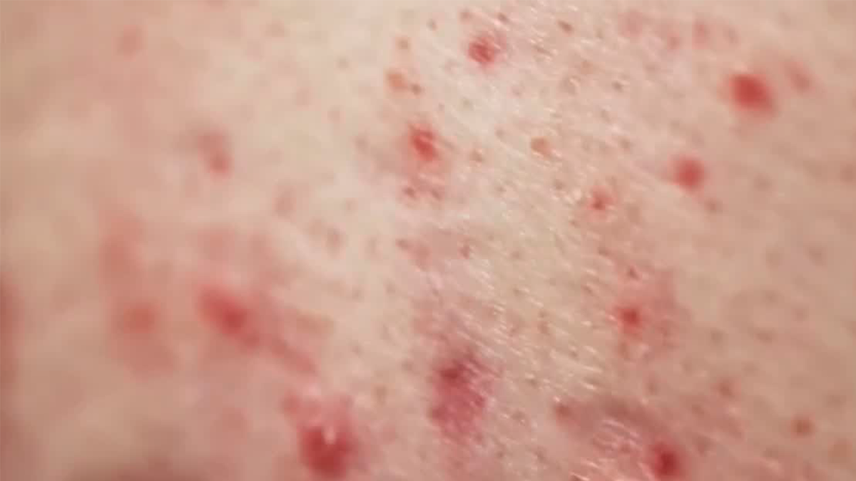 África recibe primeras vacunas contra la viruela del mono