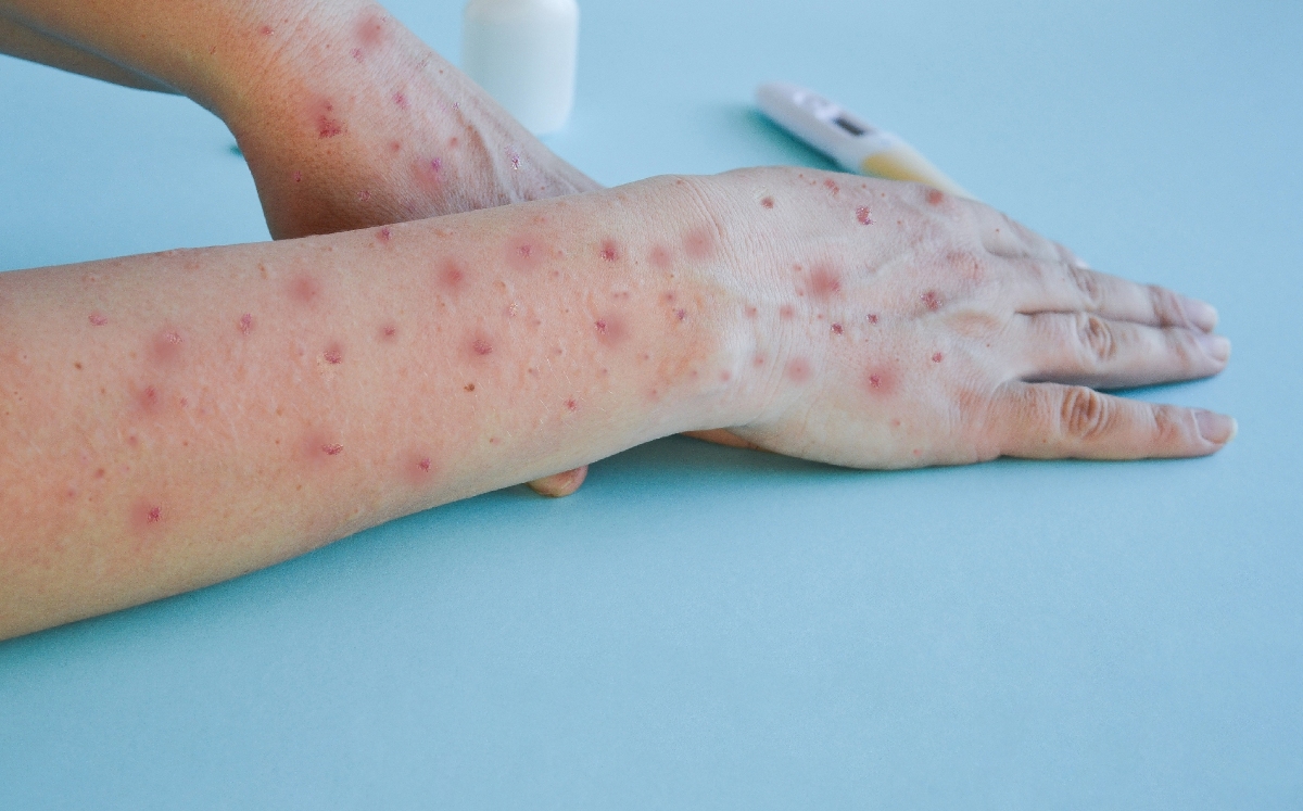 Los casos de viruela del mono han aumentado en el país en las últimas semanas. | Shutterstock